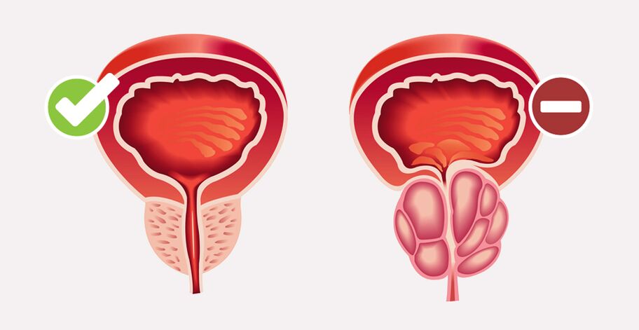 Weiprost normaliséiert d'Gréisst an d'Funktioun vun der Prostata