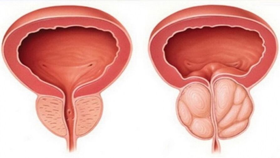 gesond an entzündegt Prostata mat Prostatitis