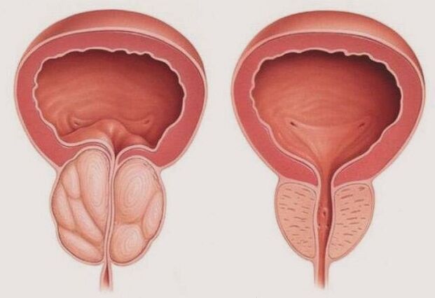 gesond an entzündegt Prostata mat Prostatitis