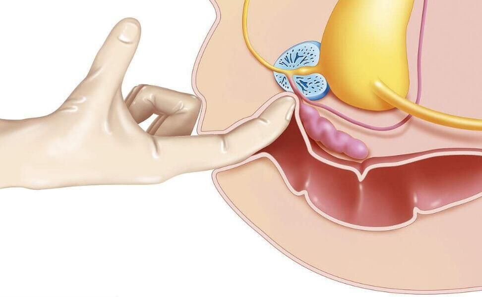 Prostata Massage fir Prostatitis Behandlung